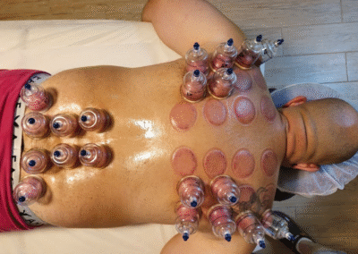 Cupping on back