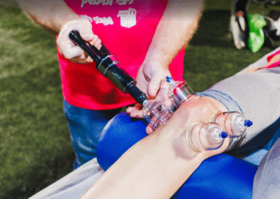 Cupping on knee