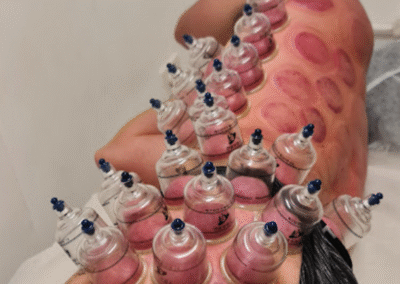 cupping on side of body