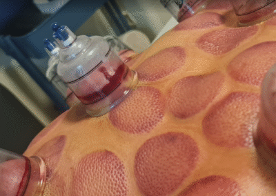 cupping to remove toxins