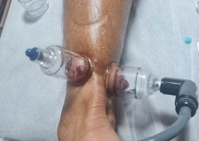 Cupping archilles