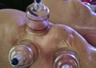 Cupping around knee