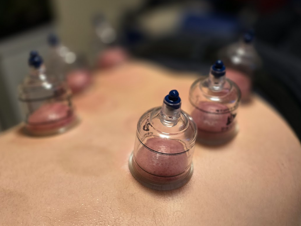 Cupping